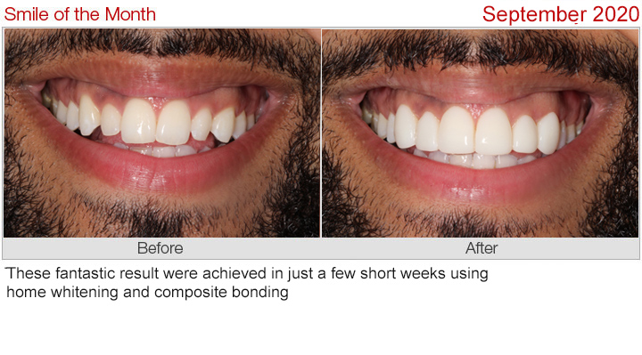 smile makeover before and after